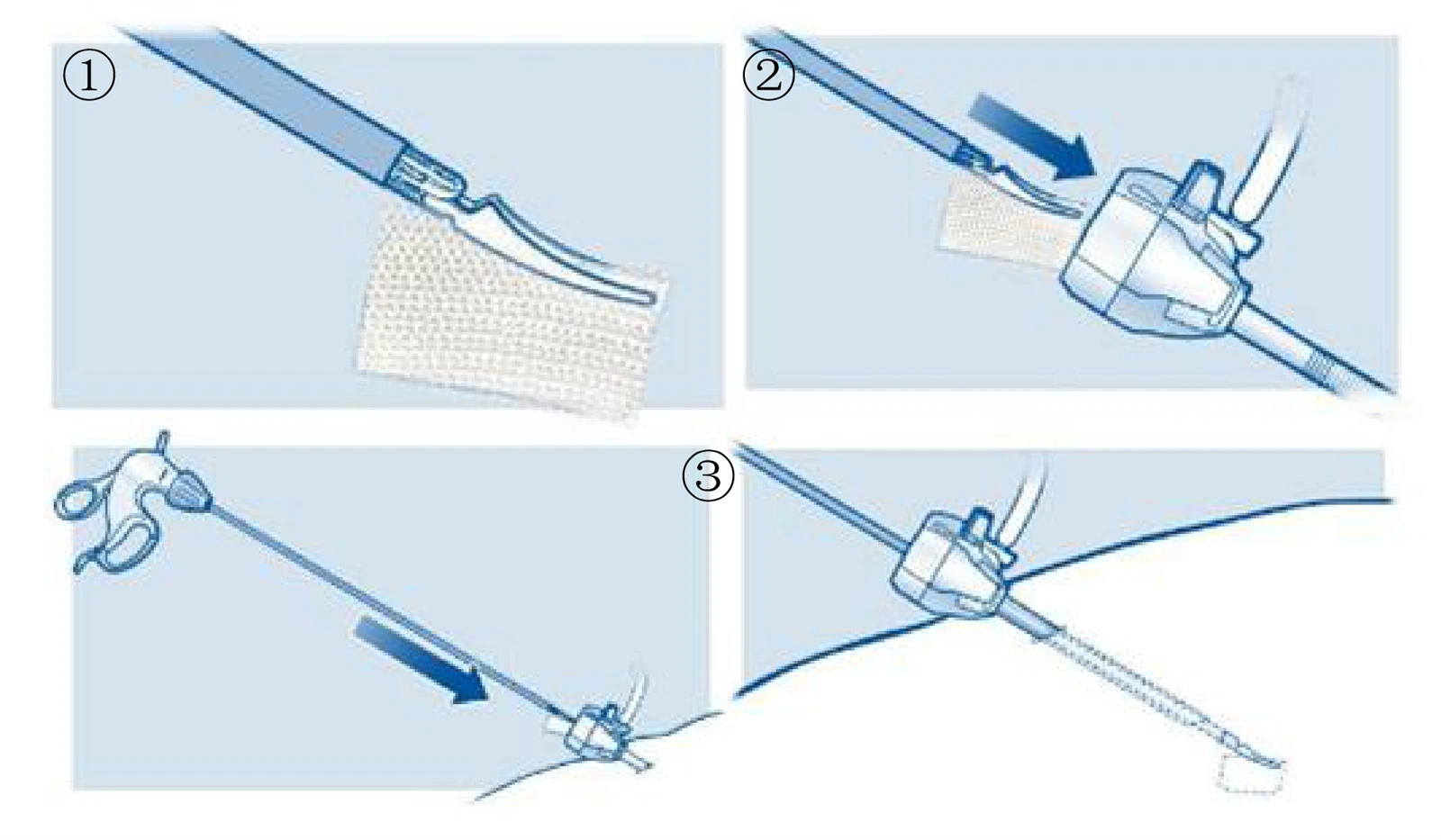 Hemostatic-Gauze-Pad Hemostatic-Gauze-Pad